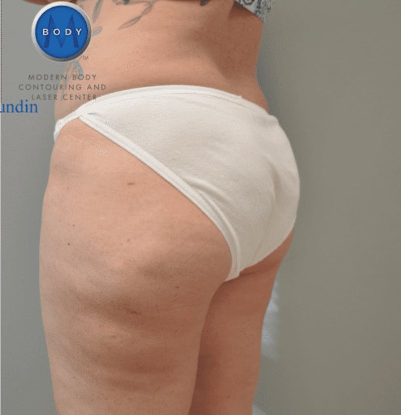 Liposuction Before & After Gallery - Patient 211876605 - Image 6