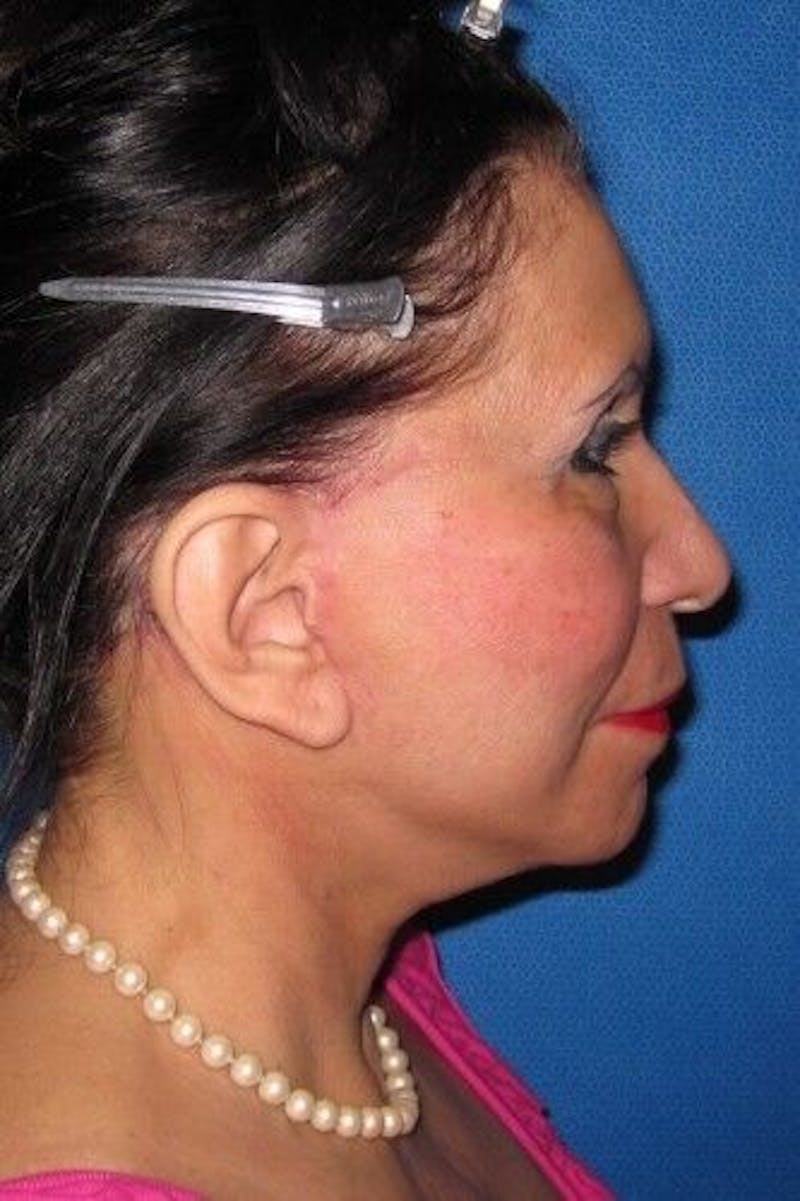 Browlift Before & After Gallery - Patient 55345552 - Image 4
