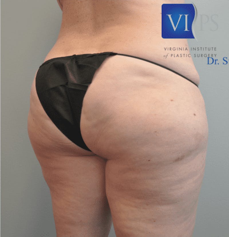 Renuvion J-Plasma Before & After Gallery - Patient 211876550 - Image 7