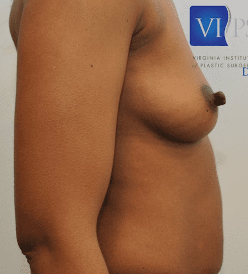 Breast Augmentation Gallery - Patient 55345557 - Image 5