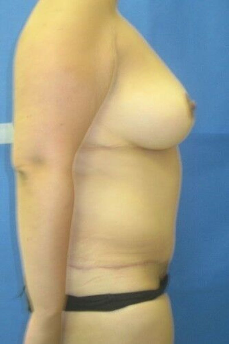 Tummy Tuck Before & After Gallery - Patient 55345554 - Image 4