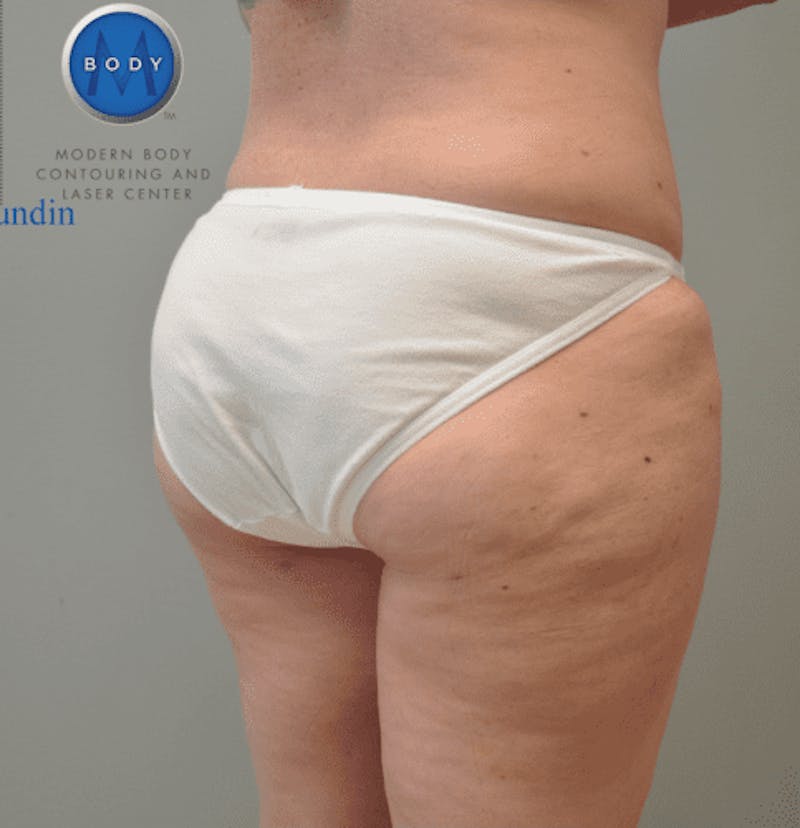 Liposuction Before & After Gallery - Patient 211876605 - Image 8
