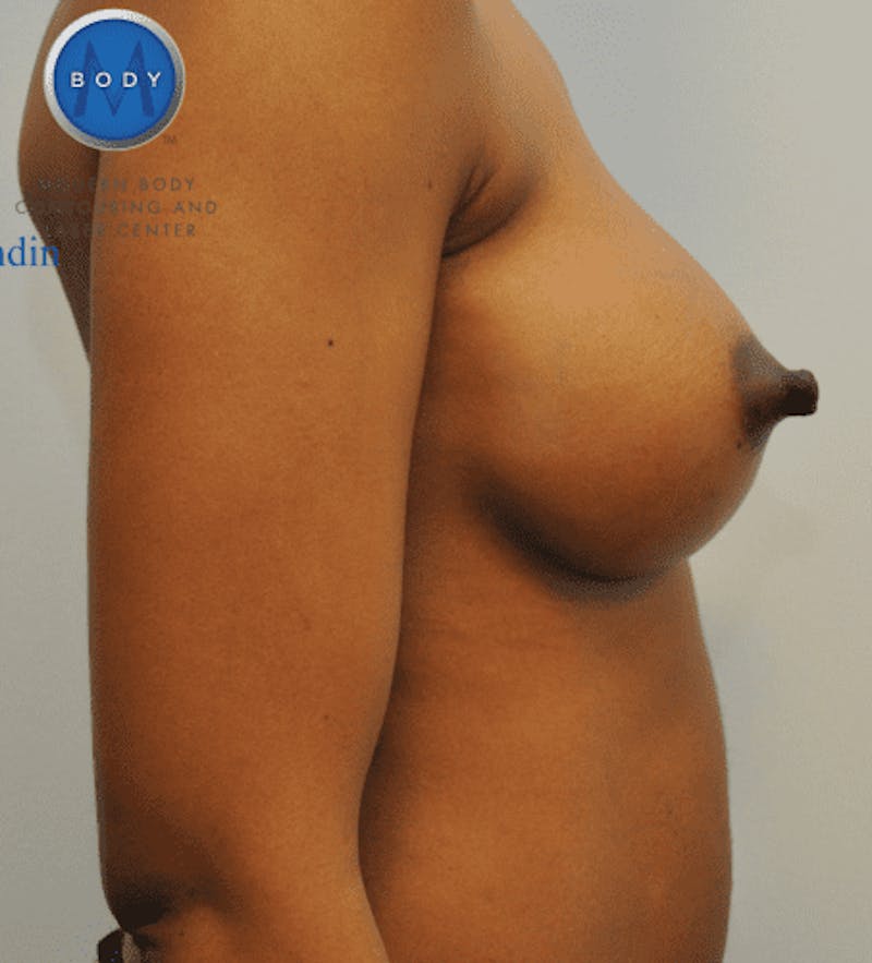 Breast Augmentation Before & After Gallery - Patient 55345557 - Image 6