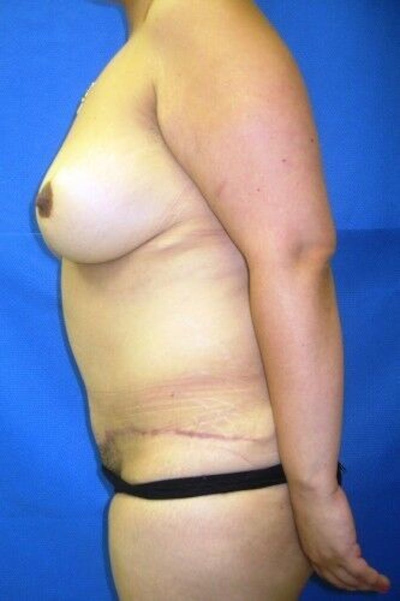 Tummy Tuck Before & After Gallery - Patient 55345554 - Image 6