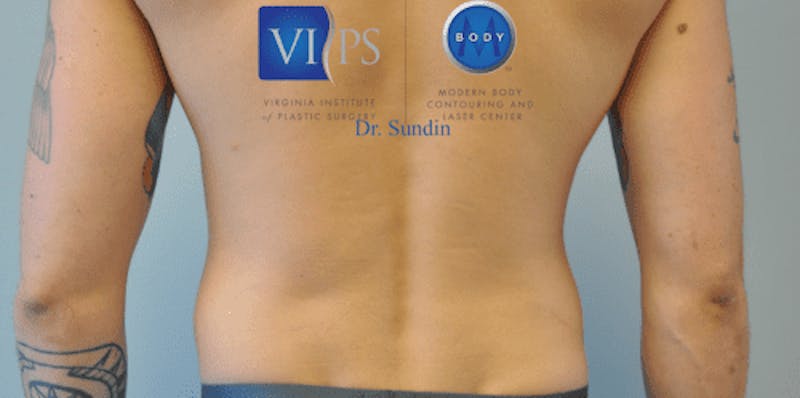 Liposuction Before & After Gallery - Patient 211876601 - Image 1