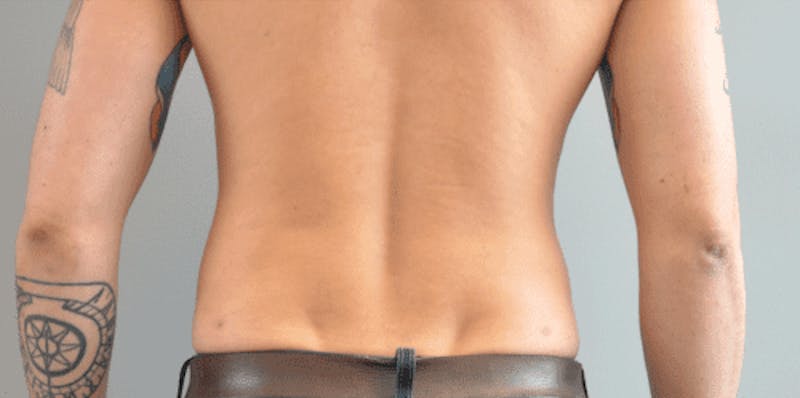 Liposuction Gallery - Patient 55345555 - Image 2