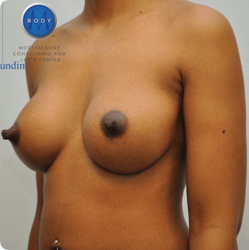 Breast Augmentation Before & After Gallery - Patient 55345557 - Image 8