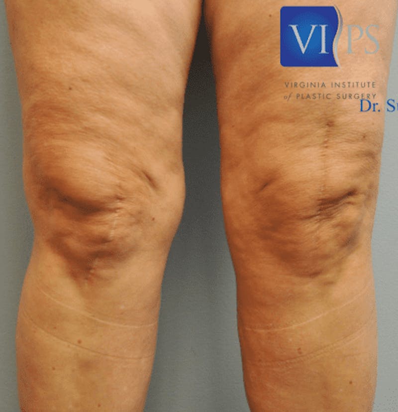 Renuvion J-Plasma Before & After Gallery - Patient 211876553 - Image 1