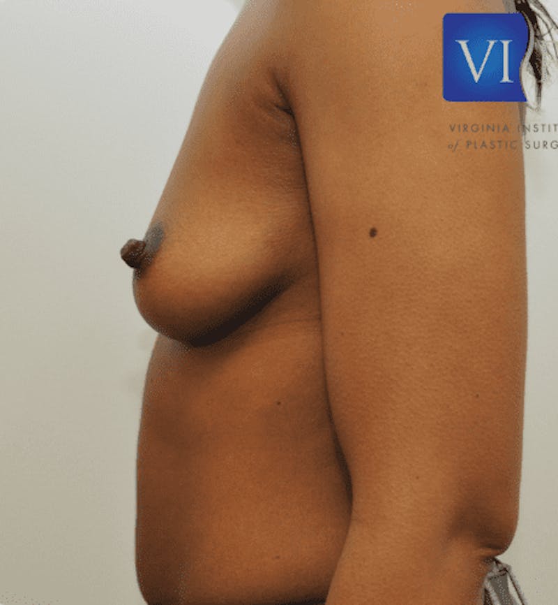 Breast Augmentation Before & After Gallery - Patient 55345557 - Image 9