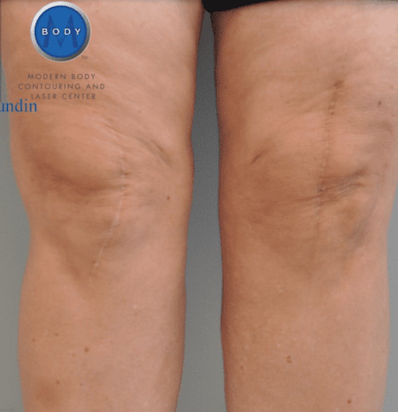 Renuvion J-Plasma Before & After Gallery - Patient 211876553 - Image 2