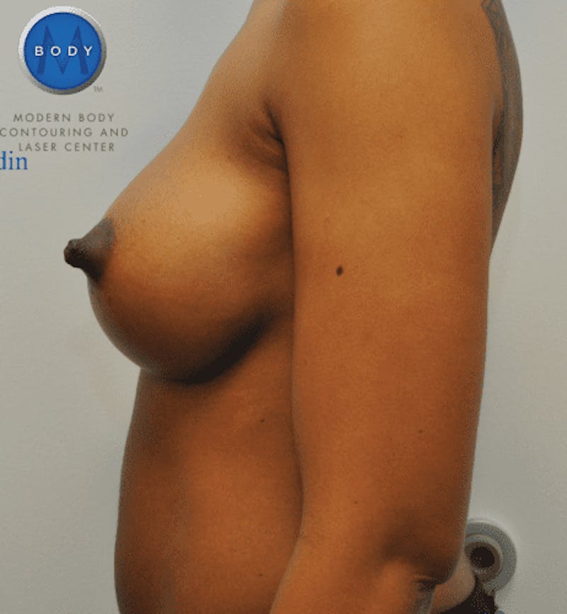 Breast Augmentation Before & After Gallery - Patient 55345557 - Image 10
