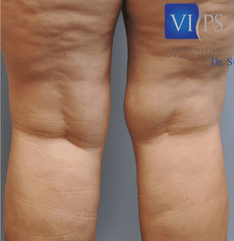 Liposuction Before & After Gallery - Patient 211876610 - Image 3