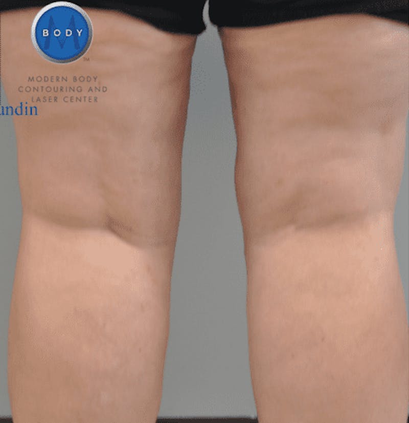 Renuvion J-Plasma Before & After Gallery - Patient 211876553 - Image 4