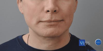 Chin Implant Before & After Gallery - Patient 55345569 - Image 2
