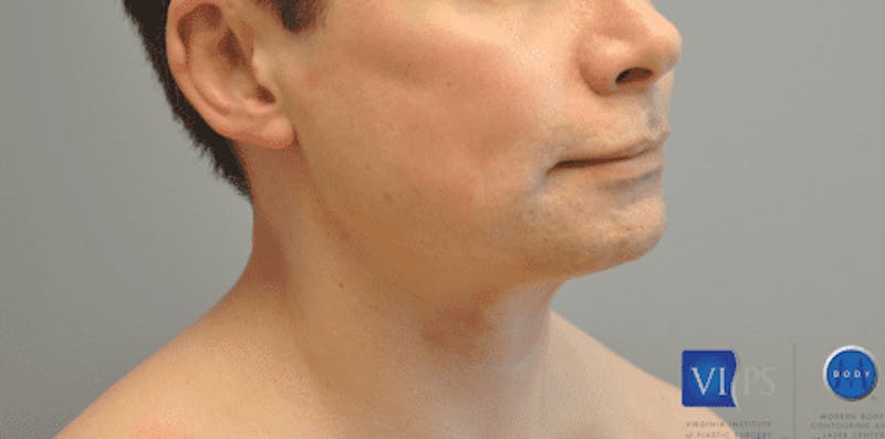 Chin Implant Before & After Gallery - Patient 55345569 - Image 3