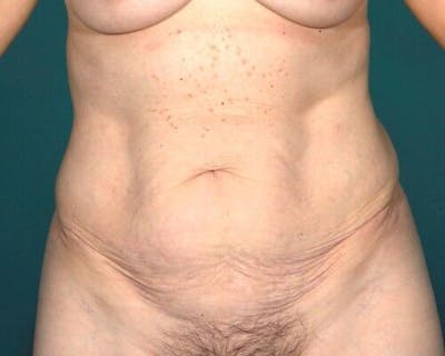 Tummy Tuck Before & After Gallery - Patient 55345566 - Image 1