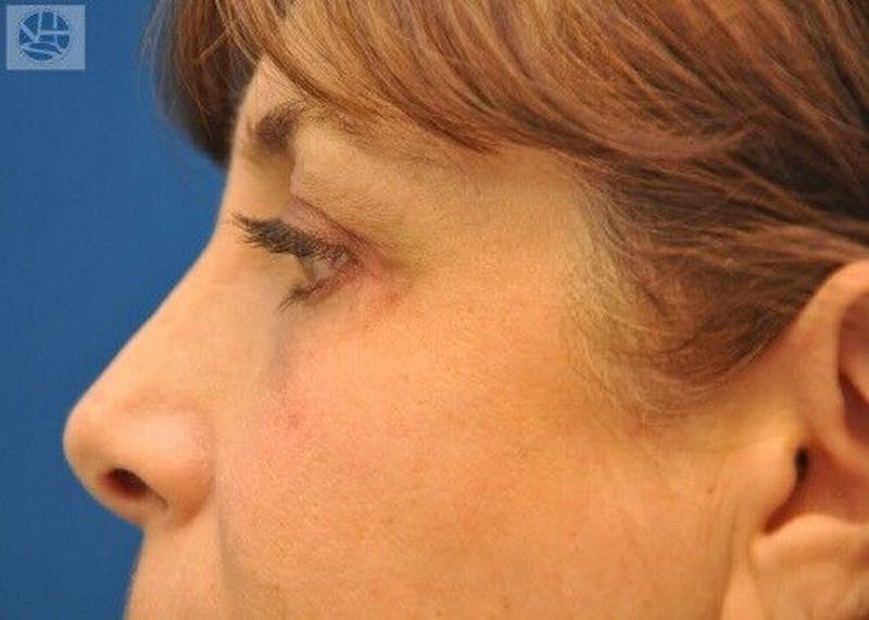 Eyelid Surgery Before & After Gallery - Patient 55345561 - Image 6