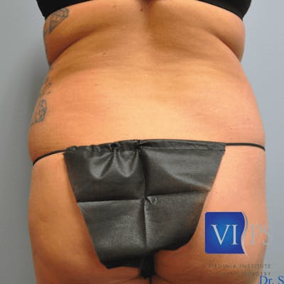 Liposuction Before & After Gallery - Patient 211876606 - Image 1