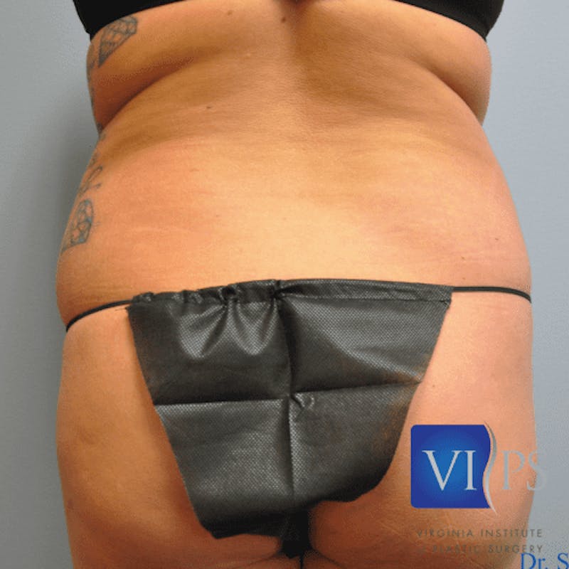 Liposuction Before & After Gallery - Patient 55345570 - Image 1