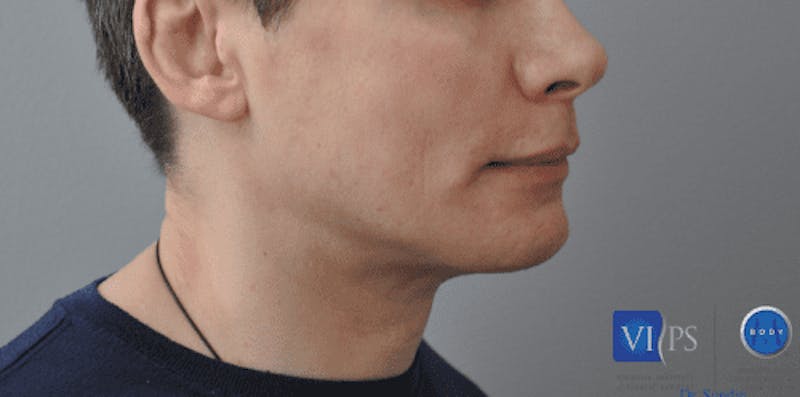 Chin Implant Before & After Gallery - Patient 55345569 - Image 4