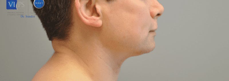 Chin Implant Before & After Gallery - Patient 55345569 - Image 5