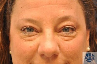 Eyelid Surgery Before & After Gallery - Patient 55345567 - Image 1