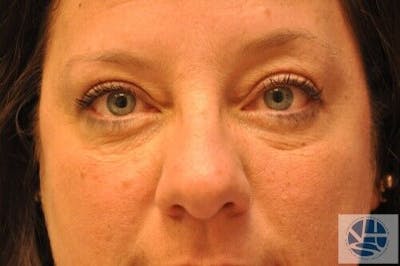 Eyelid Surgery Before & After Gallery - Patient 55345567 - Image 2