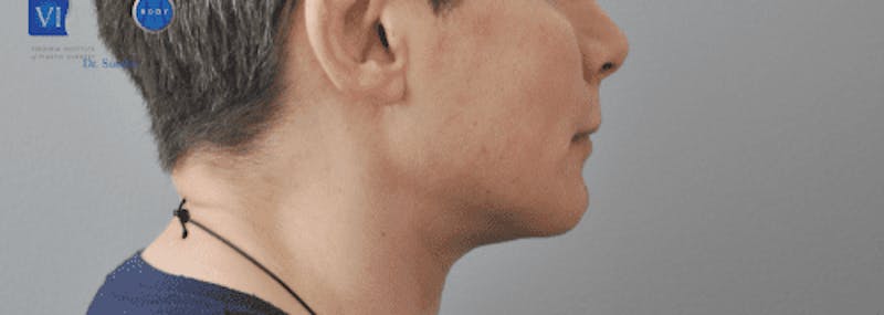 Chin Implant Before & After Gallery - Patient 55345569 - Image 6