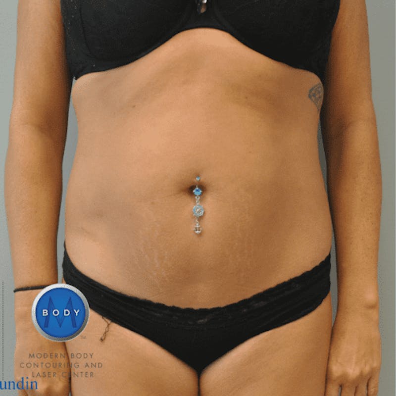 Renuvion J-Plasma Before & After Gallery - Patient 211876551 - Image 4