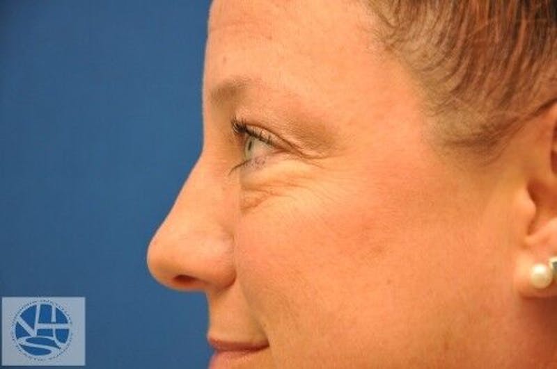 Eyelid Surgery Before & After Gallery - Patient 55345567 - Image 3