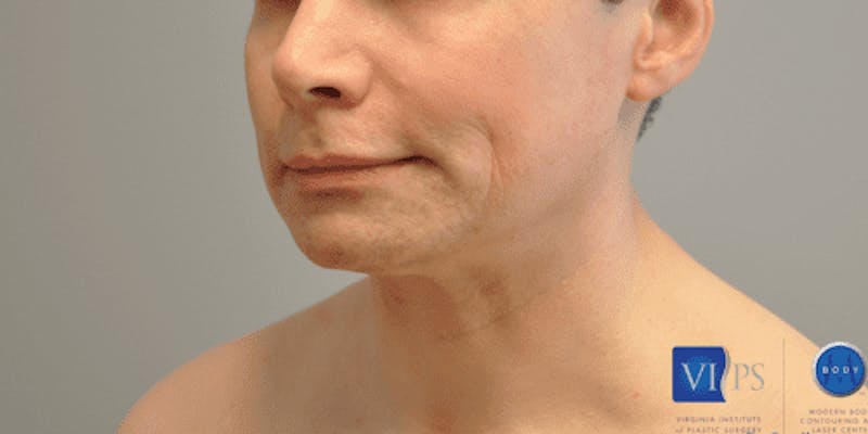Chin Implant Before & After Gallery - Patient 55345569 - Image 7