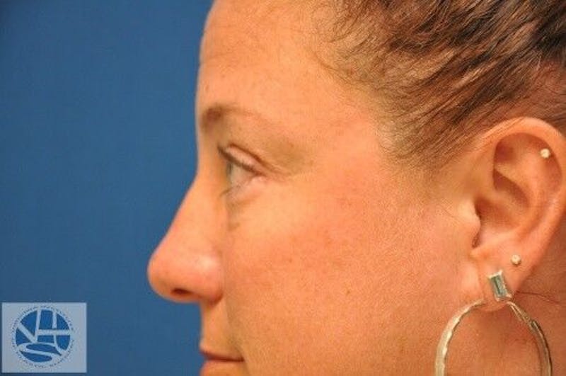 Eyelid Surgery Before & After Gallery - Patient 55345567 - Image 4