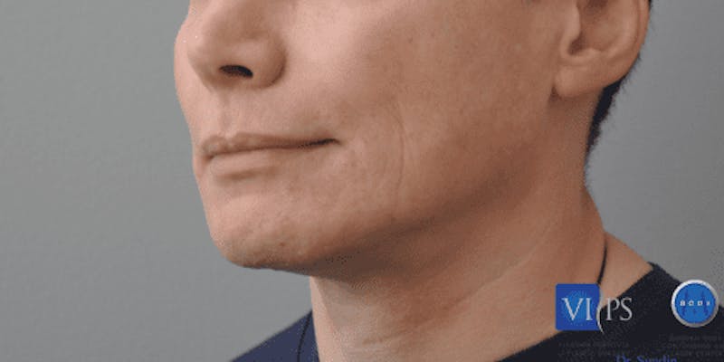Chin Implant Before & After Gallery - Patient 55345569 - Image 8