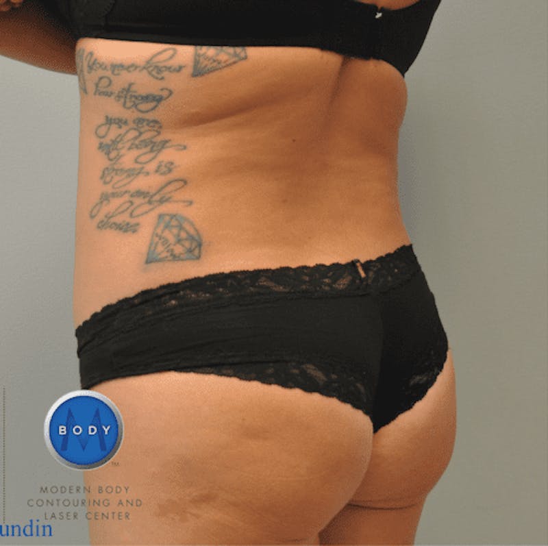 Renuvion J-Plasma Before & After Gallery - Patient 211876551 - Image 6