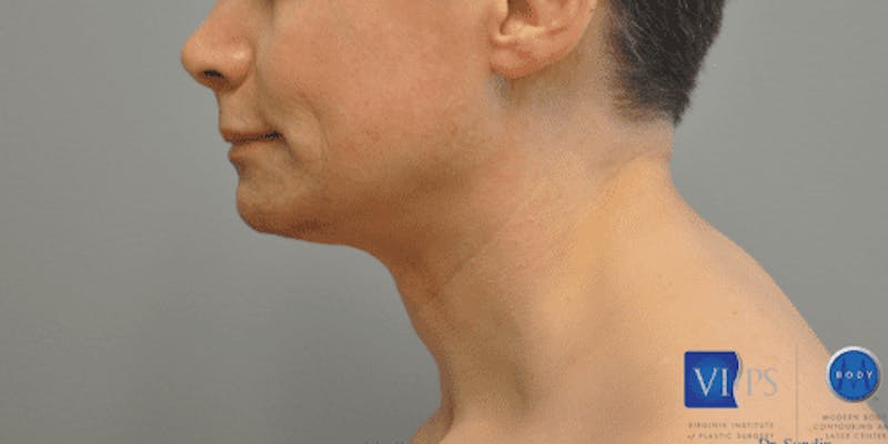 Chin Implant Before & After Gallery - Patient 55345569 - Image 9