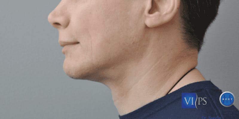 Chin Implant Before & After Gallery - Patient 55345569 - Image 10
