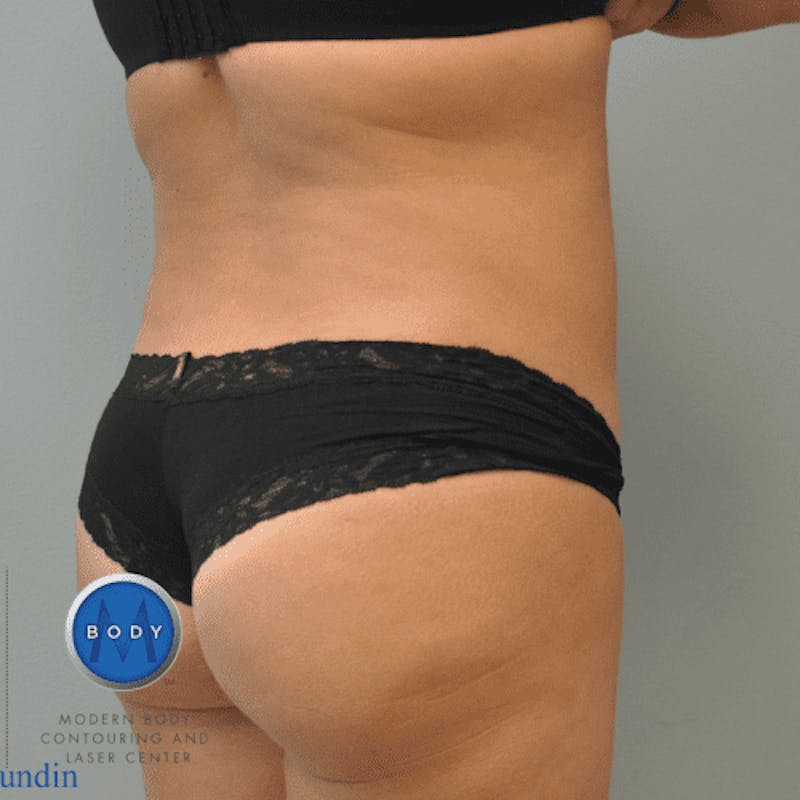 Renuvion J-Plasma Before & After Gallery - Patient 211876551 - Image 8