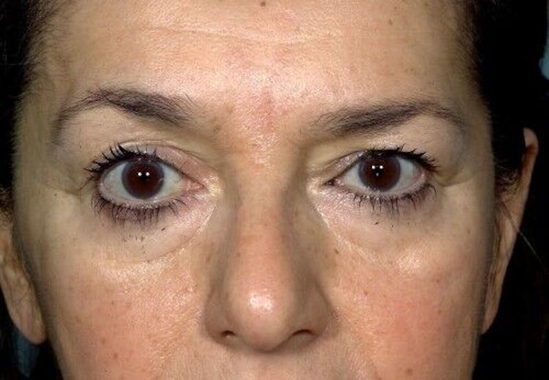 Eyelid Surgery Before & After Gallery - Patient 55345576 - Image 1