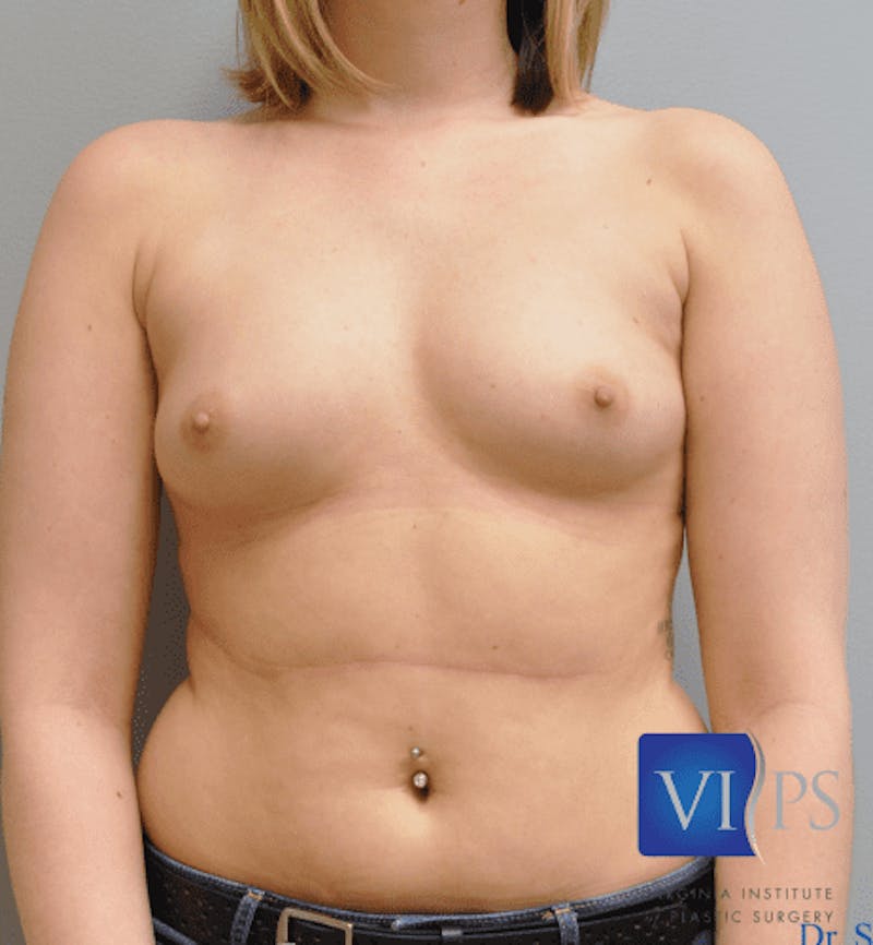 Breast Augmentation Gallery - Patient 55345574 - Image 1
