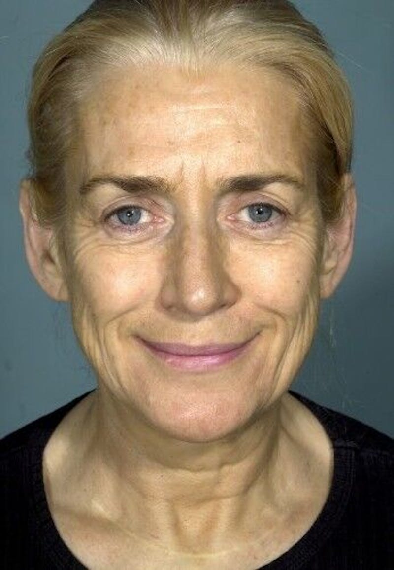 Facelift Before & After Gallery - Patient 55345573 - Image 1