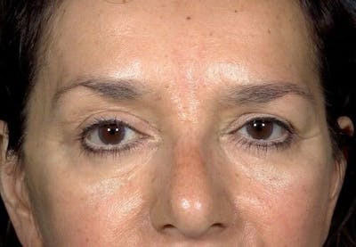 Eyelid Surgery Before & After Gallery - Patient 55345576 - Image 2