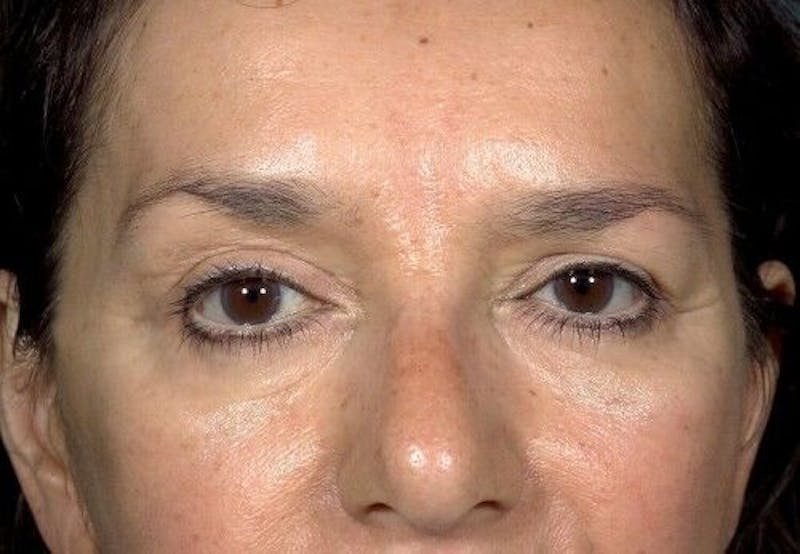 Eyelid Surgery Before & After Gallery - Patient 55345576 - Image 2