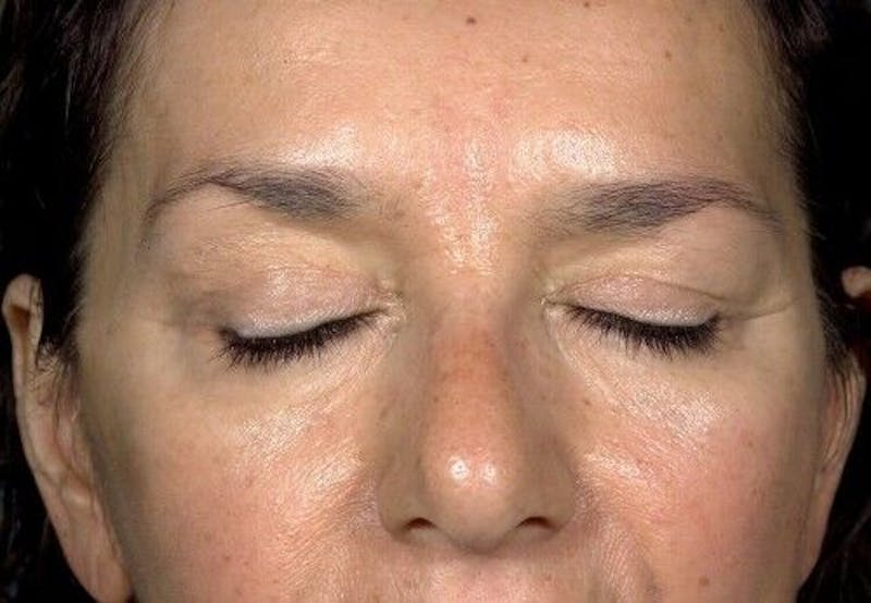 Eyelid Surgery Before & After Gallery - Patient 55345576 - Image 3