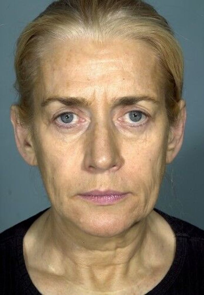 Facelift Before & After Gallery - Patient 55345573 - Image 3