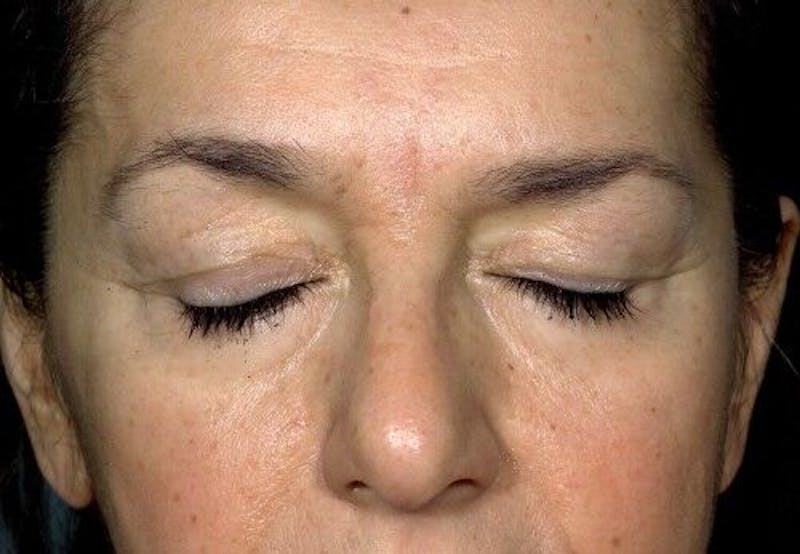 Eyelid Surgery Before & After Gallery - Patient 55345576 - Image 4