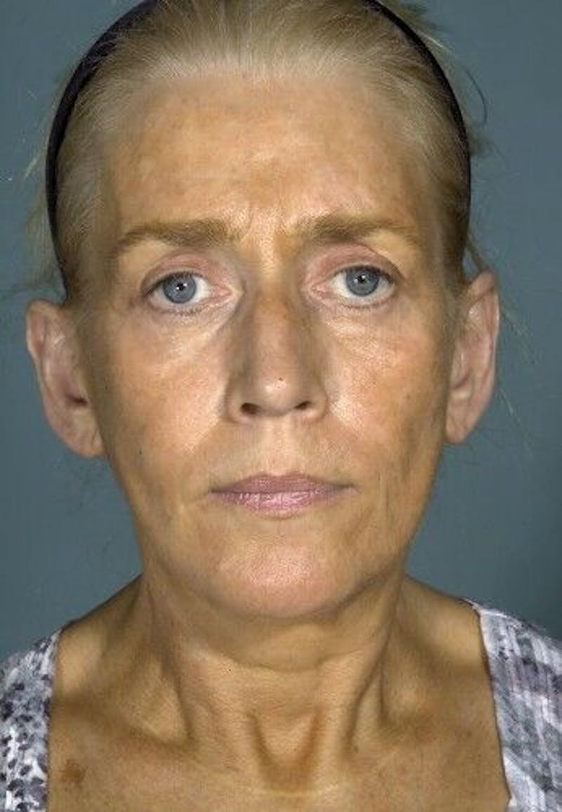 Facelift Before & After Gallery - Patient 55345573 - Image 4