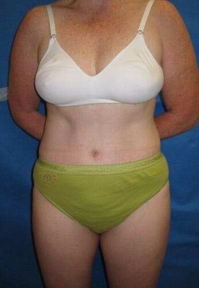 Tummy Tuck Before & After Gallery - Patient 55345582 - Image 2
