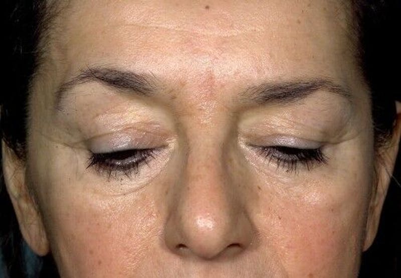 Eyelid Surgery Before & After Gallery - Patient 55345576 - Image 5