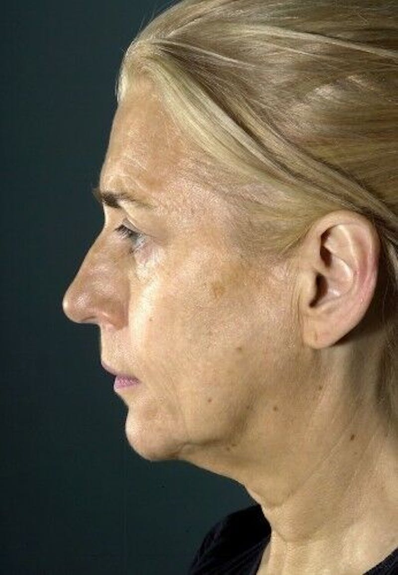 Facelift Before & After Gallery - Patient 55345573 - Image 5