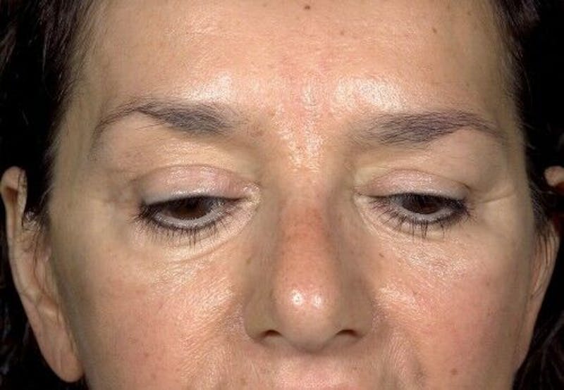 Eyelid Surgery Before & After Gallery - Patient 55345576 - Image 6